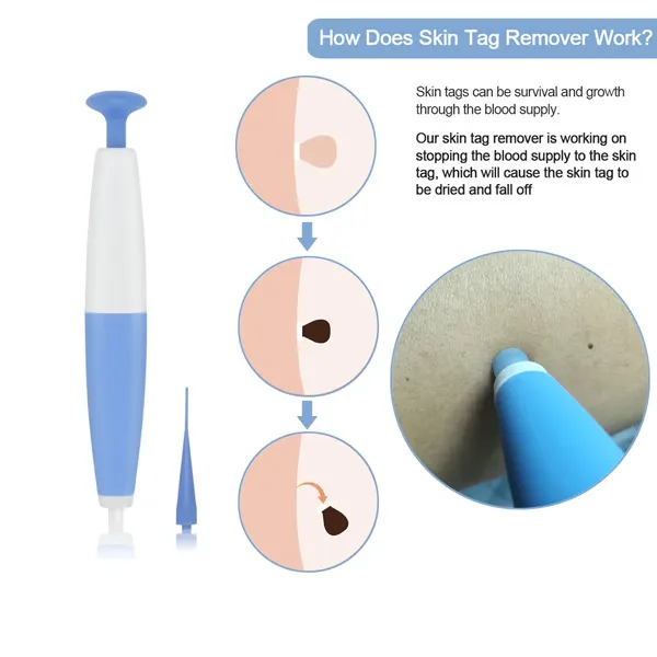 Auto Skin Tag Removal Kit - Easy At-Home Skin Tag Remover