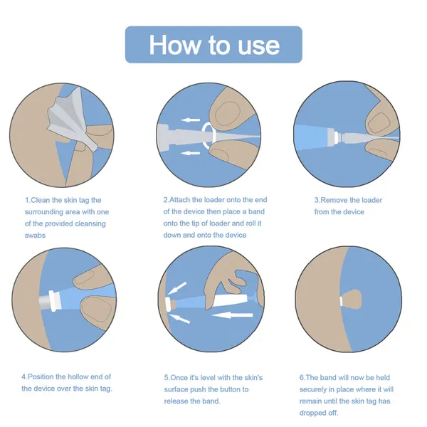 Auto Skin Tag Removal Kit - Easy At-Home Skin Tag Remover